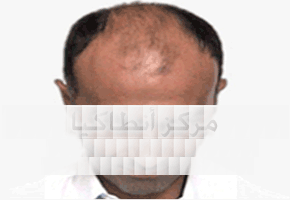 Before Hair Transplantation